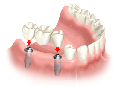 Implant-Supported-Bridge-put-label-under-photo-below-fixed-implant-section
