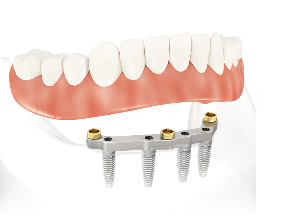implant supported denture put on implant loosen up denture spot