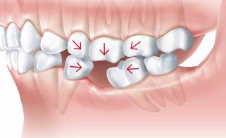 why replace replace missing teeth on implant and bridge page